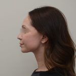 Facelift Before & After Patient #3934