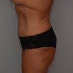 Abdominoplasty Before & After Patient #3932