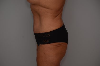 Abdominoplasty Before & After Patient #3932