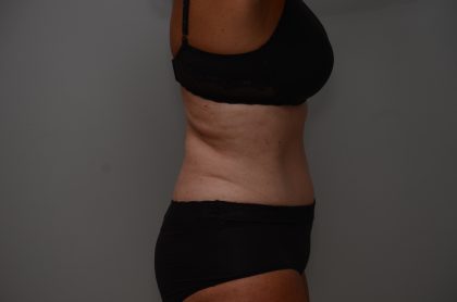 Abdominoplasty Before & After Patient #3933