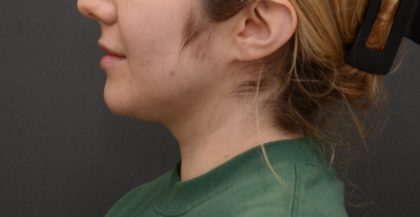 Facetite Before & After Patient #3937