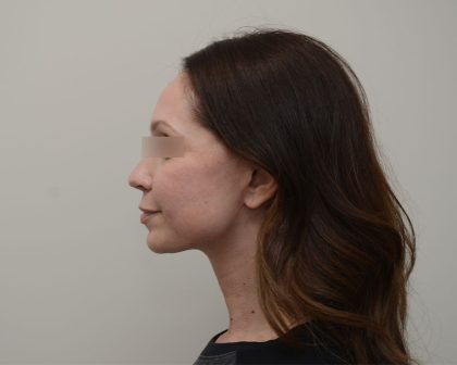 Facelift Before & After Patient #3934