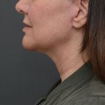 Mini Facelift Before & After Patient #3942