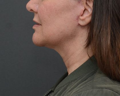 Mini Facelift Before & After Patient #3942