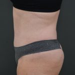 Abdominoplasty Before & After Patient #3938