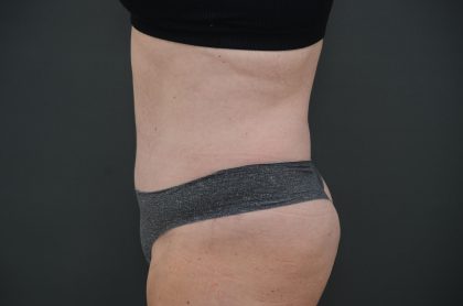 Abdominoplasty Before & After Patient #3938