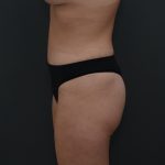 Abdominoplasty Before & After Patient #3941