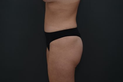 Abdominoplasty Before & After Patient #3941
