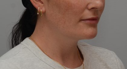 Neck Liposuction Before & After Patient #3935