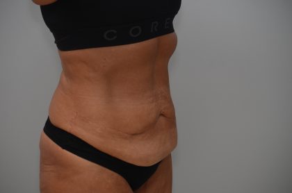 Abdominoplasty Before & After Patient #3932