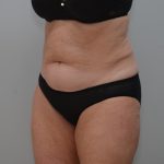 Abdominoplasty Before & After Patient #3933