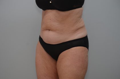 Abdominoplasty Before & After Patient #3933