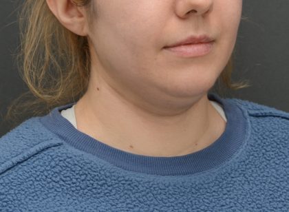 Facetite Before & After Patient #3937