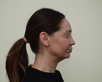 Facelift Before & After Patient #3934