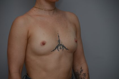 Breast Augmentation Before & After Patient #3936