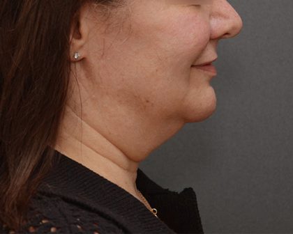 Mini Facelift Before & After Patient #3942