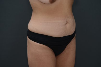 Abdominoplasty Before & After Patient #3941