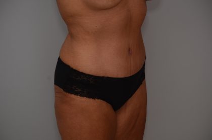 Abdominoplasty Before & After Patient #3932
