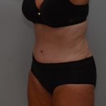Abdominoplasty Before & After Patient #3933