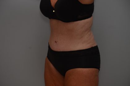 Abdominoplasty Before & After Patient #3933