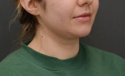 Facetite Before & After Patient #3937