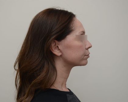 Facelift Before & After Patient #3934