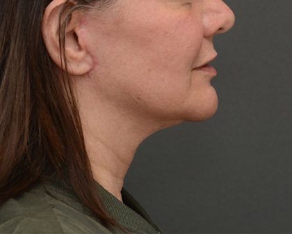 Mini Facelift Before & After Patient #3942