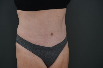 Abdominoplasty Before & After Patient #3938