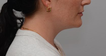 Neck Liposuction Before & After Patient #3935