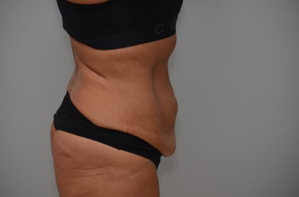 Abdominoplasty Before & After Patient #3932