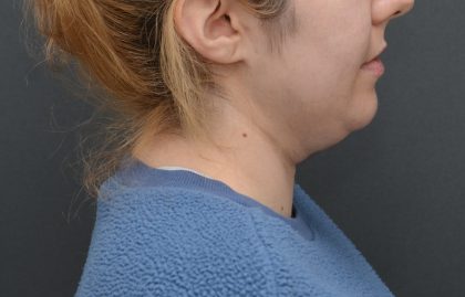 Facetite Before & After Patient #3937