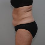 Abdominoplasty Before & After Patient #3933