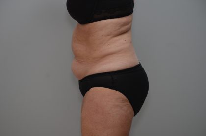 Abdominoplasty Before & After Patient #3933