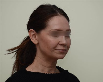 Facelift Before & After Patient #3934