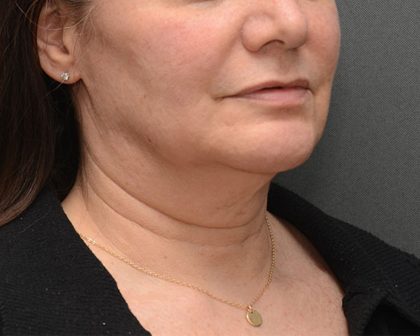 Mini Facelift Before & After Patient #3942