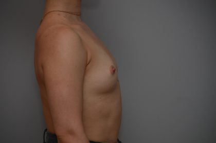 Breast Augmentation Before & After Patient #3936