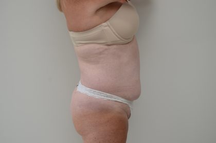 Abdominoplasty Before & After Patient #3938