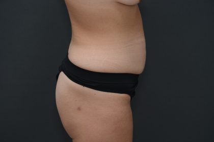 Abdominoplasty Before & After Patient #3941